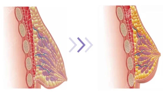 قمصان LunaLift™ InflateUP الجرمانيوم للسيدات