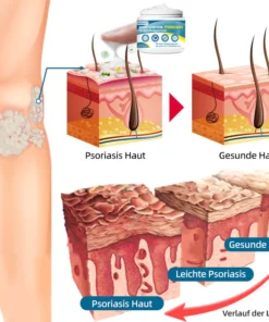 Ourlyard™ Multi-Symptom Psoriasis-Behandlungscreme