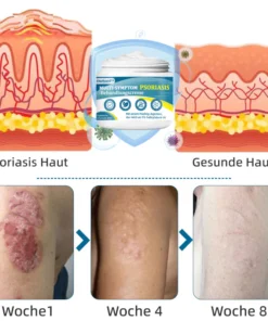 Ourlyard™ Multi-Symptom Psoriasis-Behandlungscreme