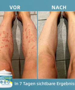 Ourlyard™ Multi-Symptom Psoriasis-Behandlungscreme