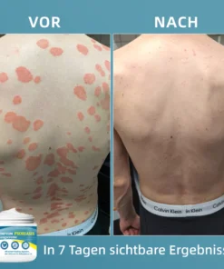 Ourlyard™ Multi-Symptom Psoriasis-Behandlungscreme