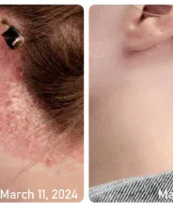 Ourlyard™ Psoriasis Moisturizing and Soothing Cream