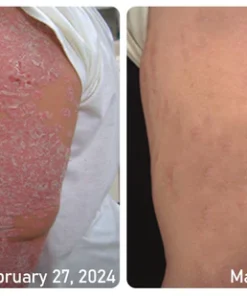 Ourlyard™ Psoriasis Moisturizing and Soothing Cream