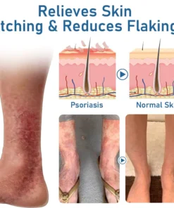 Alternative view of Ourlyard™ Psoriasis Moisturizing and Soothing Cream