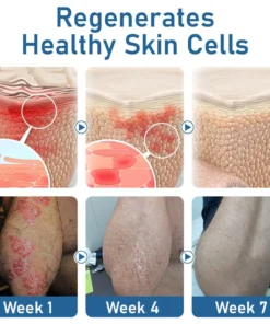 Ourlyard™ Psoriasis Moisturizing and Soothing Cream