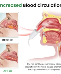 جهاز Oveallgo™ AuraGlow لعلاج الأنف بتقنية LED