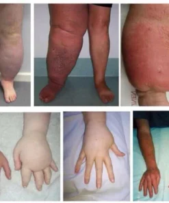 Oveallgo™ LymphTox Bee Venom Foot Soak