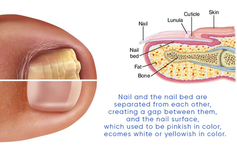 Oveallgo™ OnyxoGuard Nail Growth and Repair Serum