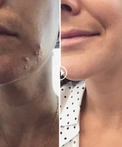 Oveallgo™ WartsOff Instant Blemish Removal Cream - PREMIUM