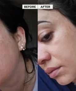 REMoDY for dark spots