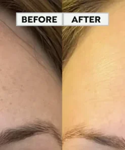 REMoDY for dark spots