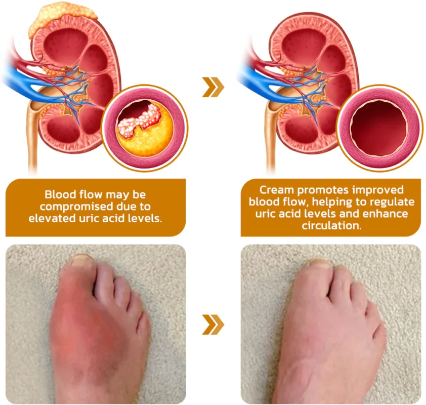 flysmus™ Bee Venom Hyperuricemia Anti-Infection Cream