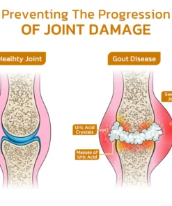 flysmus™ Bee Venom Hyperuricemia Anti-Infection Cream