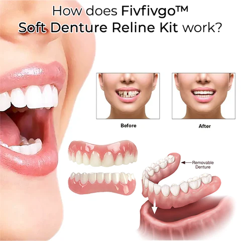 Oveallgo™ pehmeä hammasproteesi Reline Kit