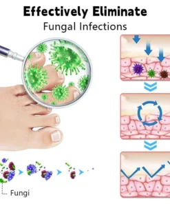 Biancat™ Nail Fungus Laser Cleaning Repair Device