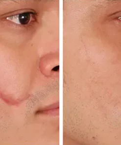 Ceoerty™ Skin Renewal Scar Spray