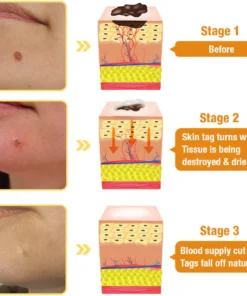 Dobshow™ Bee Venom Skin Perfection Spray: Erase Tags & Warts Naturally