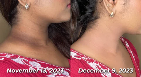 Dobshow™ ShineLuster Bee Venom Clinical Strength Soap for Skin Clarity