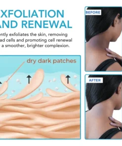 Fivfivgo™ Acanthosis Nigricans Aufhellungscreme