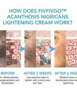 Fivfivgo™ Acanthosis Nigricans Aufhellungscreme
