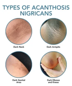 Fivfivgo™ Acanthosis Nigricans Aufhellungscreme