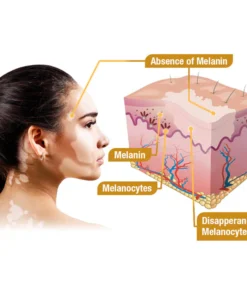 Fivfivgo™ BeeVenom Vitiligo Behandlung Creme