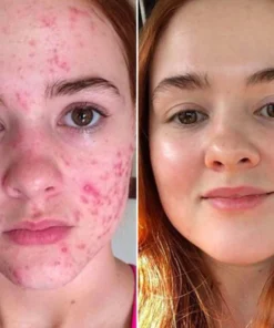 Fivfivgo™ ClariSkin 2% Salicylsäure Ausgleichendes Reparaturserum