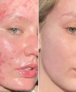 Fivfivgo™ ClariSkin 2% Salicylsäure Ausgleichendes Reparaturserum