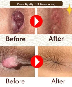 Fivfivgo™ Natürliche pflanzliche Stärke Hämorrhoiden-Kapseln