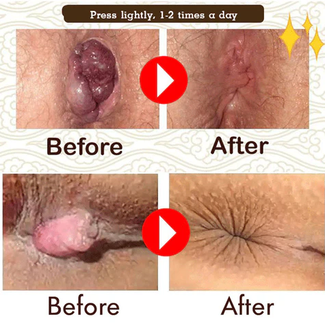 Fivfivgo™ Natürliche pflanzliche Stärke Hämorrhoiden-Kapseln