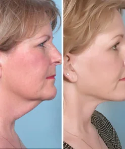 Fivfivgo™ UltraRenew ultrasoon faceliftapparaat