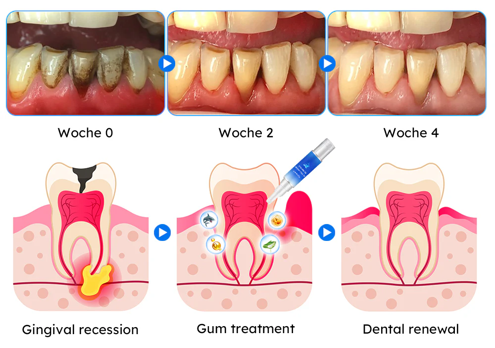 Furzero™ Haifischkollagen Zahnfleischpflege-Gel