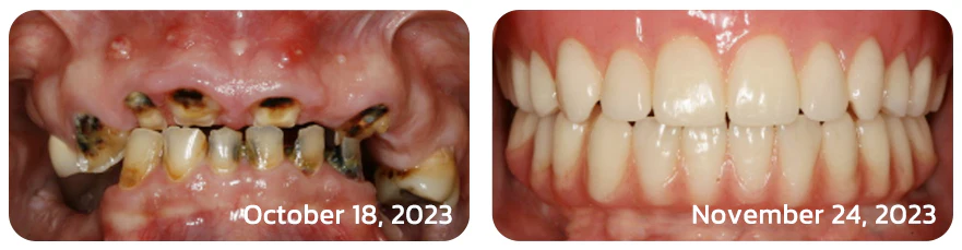 Furzero™ JoySmile Bee Venom Treatment Toothpaste