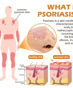 Furzero™ New Zealand Bee Venom Psoriasis Treatment Cream