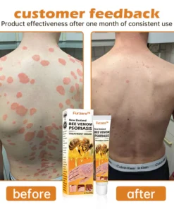 Furzero™ New Zealand Bee Venom Psoriasis Treatment Cream