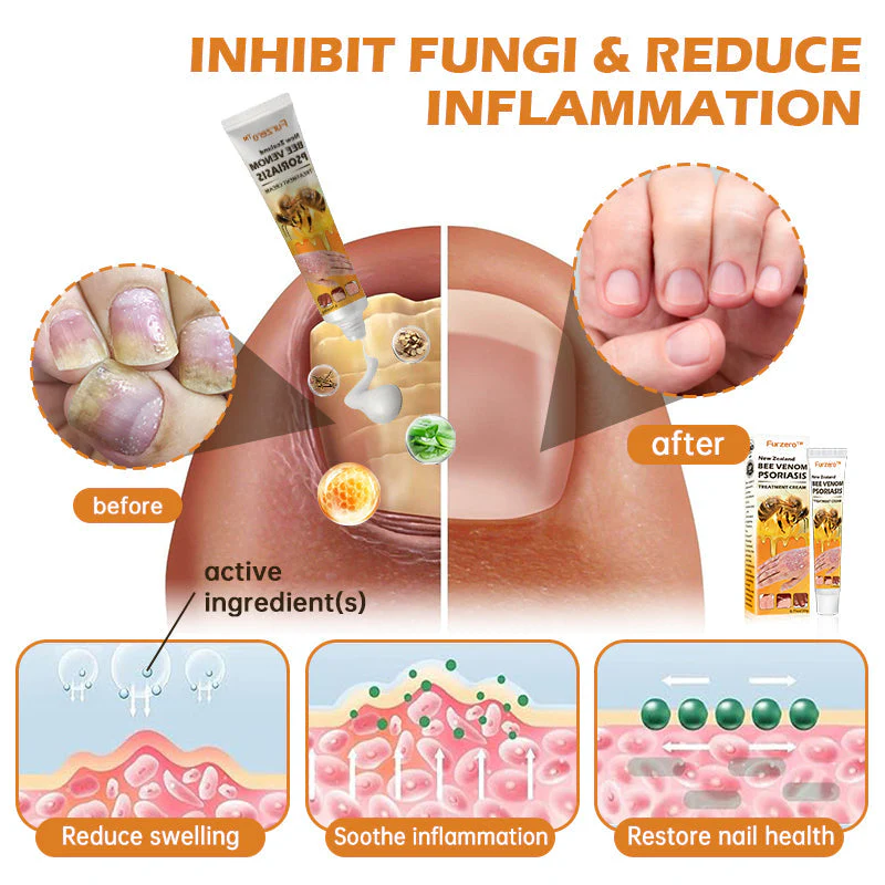 Furzero™ New Zealand Bee Venom Psoriasis Treatment Cream