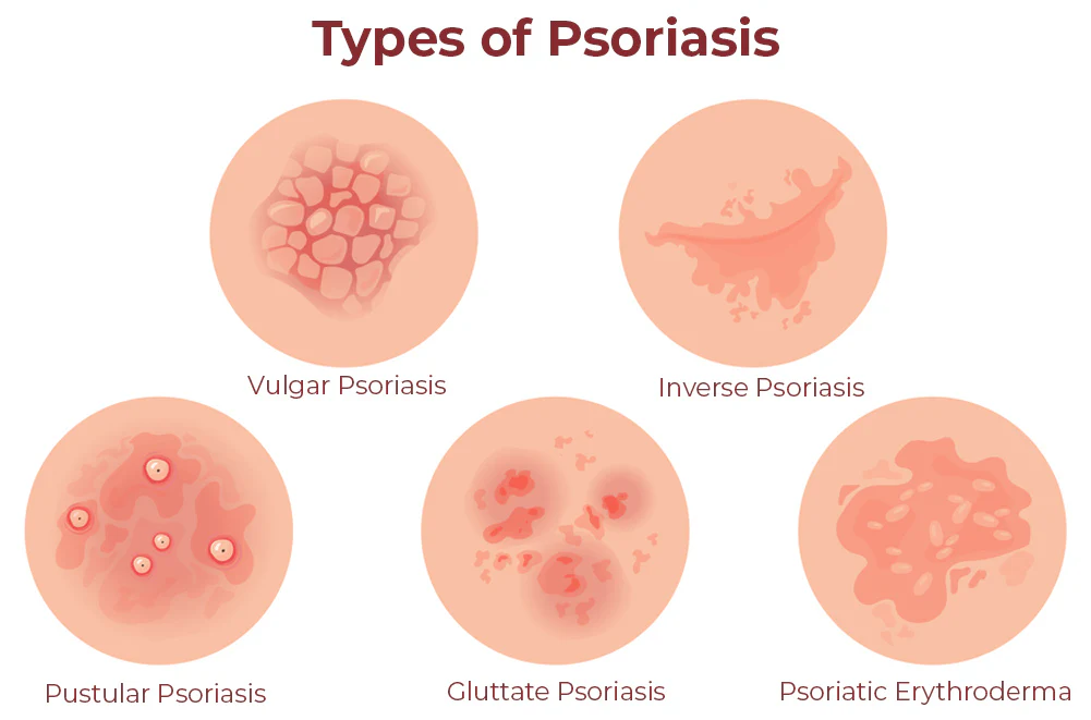 GFOUK™ Kolmax Psoriasis Relief Spray