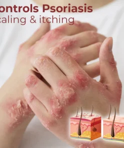 GFOUK™ Kolmax Psoriasis Relief Spray