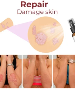 GFOUK™ Kolmax Psoriasis Relief Spray