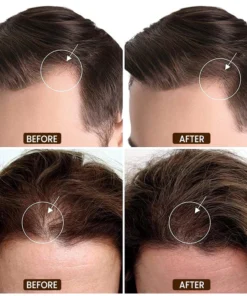 خلاصة علاج LIMETOW™ المضادة لتساقط الشعر