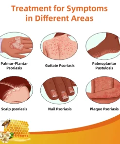 LOVILDS® Bee Venom Psoriasis Treatment Cream