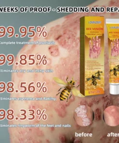 LOVILDS® Bee Venom Psoriasis Treatment Cream