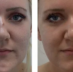 LOVILDS™ Tags & Moles Remover