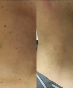 LOVILDS™ Tags & Moles Remover