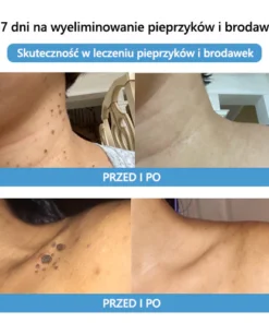 Lenaro™ Krem leczący znamiona i brodawki z jadem pszczelim