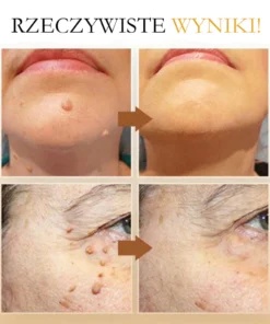 Lenaro™ Krem leczący znamiona i brodawki z jadem pszczelim