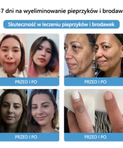 Lenaro™ Krem leczący znamiona i brodawki z jadem pszczelim