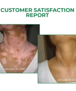Lovilds™ VitiligoFix تنشيط الإكسير