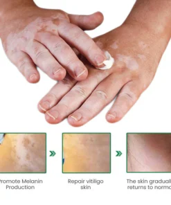 Lovilds™ VitiligoFix تنشيط الإكسير