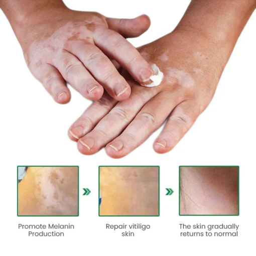 Lovilds™ VitiligoFix تنشيط الإكسير